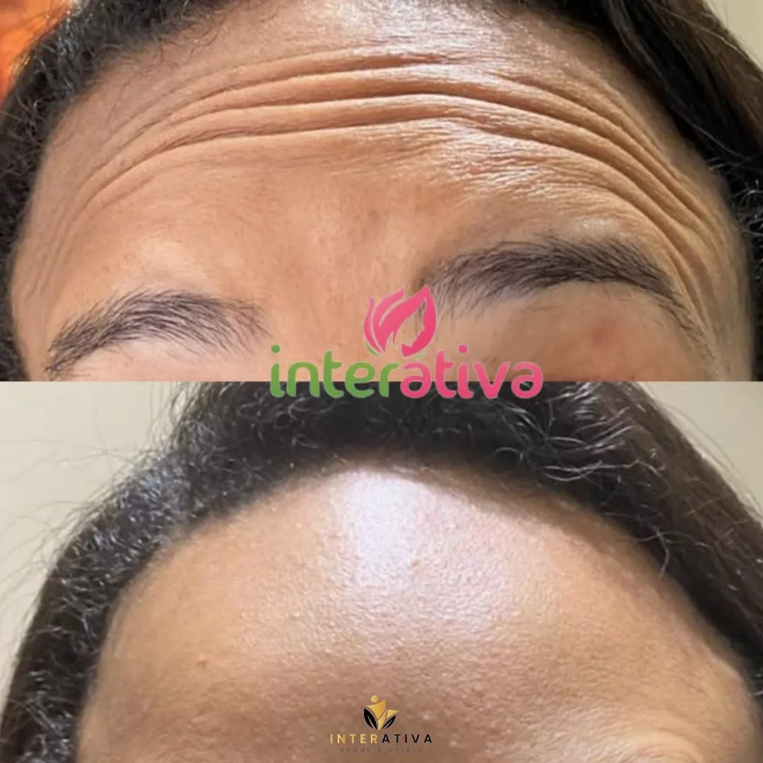 Área tratada com botox